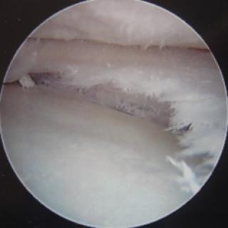 Degeneratieve meniscus